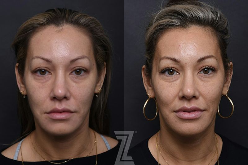 Austin Injectable Fillers Before & After Gallery - Patient 407560 - Image 1 - The Piazza Center