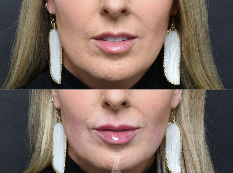 Austin Injectable Lip Fillers Comparison - The Piazza Center