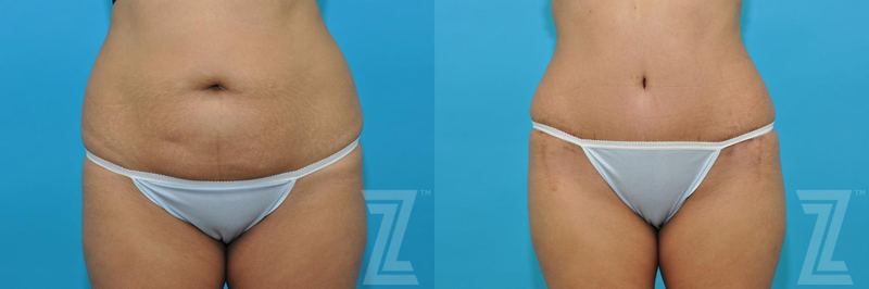 Austin Tummy Tuck Before & After Gallery - Patient 132886811 - Image 1 - The Piazza Center