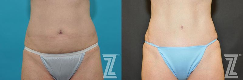 Austin Tummy Tuck Before & After Gallery - Patient 132886891 - Image 1 - The Piazza Center