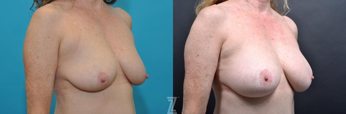 Austin 7 year post op mommy makeover Oblique breast view - The Piazza Center, Austin Tx - The Piazza Center