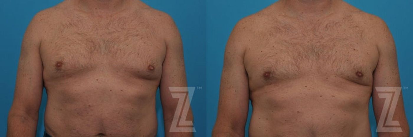 Austin Gynecomastia/Male Breast Reduction Before & After Gallery - Patient 115995 - Image 3 - The Piazza Center