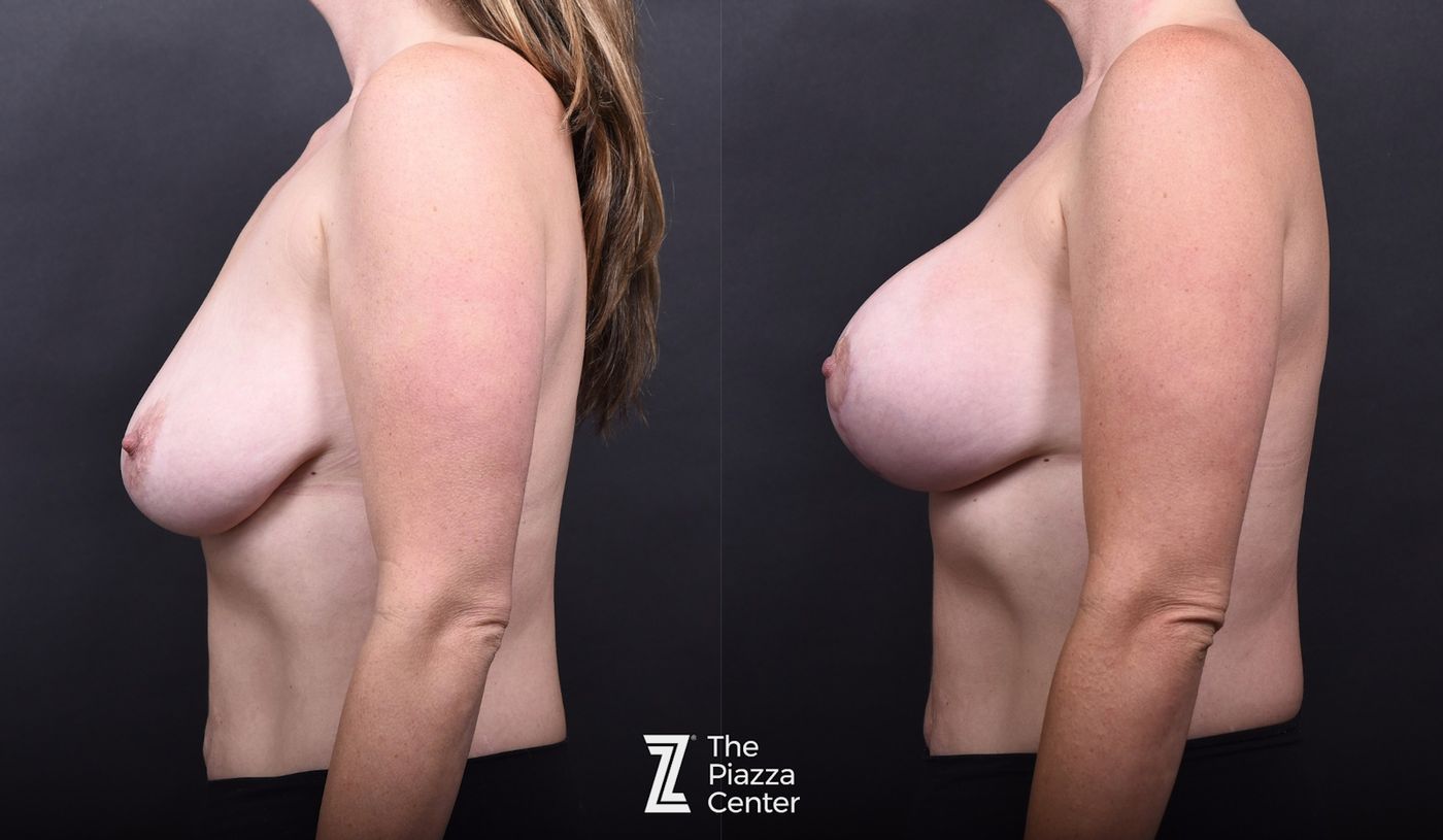 Austin Breast Augmentation Before & After Gallery - Patient 387998 - Image 5 - The Piazza Center