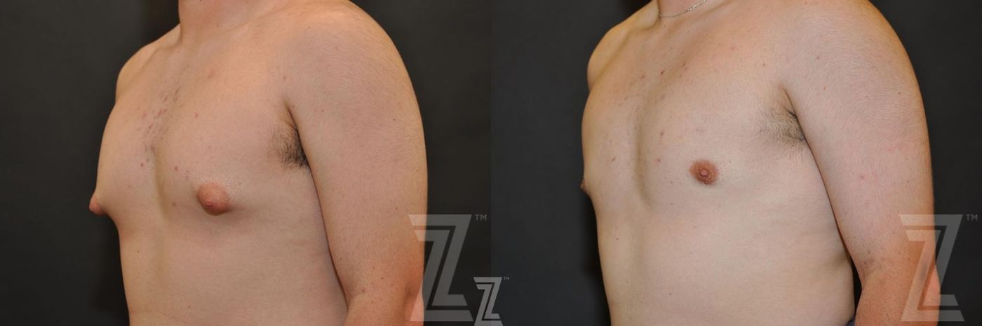Austin Male Breast Reduction Before & After Gallery - Patient 132963597 - Image 2 - The Piazza Center